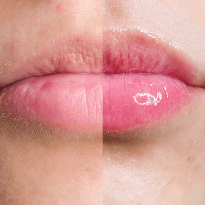 Hidratação Labial